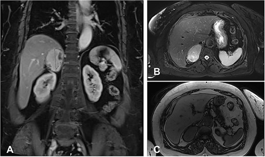 MRI Abdomen with and without IV contrast. Right adrenal mass demonstrating high T2 and low T1, with cystic changes. (A), an axial T2 weighted MRI shows a hyperintense right adrenal mass with cystic changes, abutting the liver without invasion. (B), a cross-section T2 weighted MRI shows a hyperintense large right adrenal mass. (C), cross-section T1 weighted MRI shows a large right adrenal mass characterized by hypointernse lesion compared with hepatic parenchyma.
