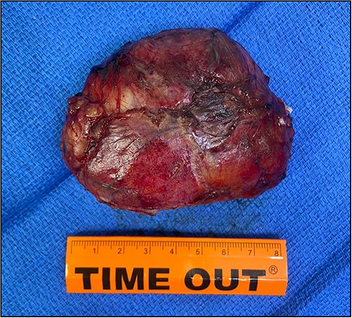 An adrenal mass with cystic and vascular-rich component that was removed surgically, measuring ⁓11 cm.