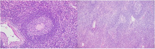 (A), Regressed germinal center shows hyalinized blood vessels, dendritic cells and mantle zone forming an ‘onion skin’ arrangement; (B), the hyalinized blood vessels together with the atretic follicles and concentric mantle zone import a ‘lollipop’ appearance.