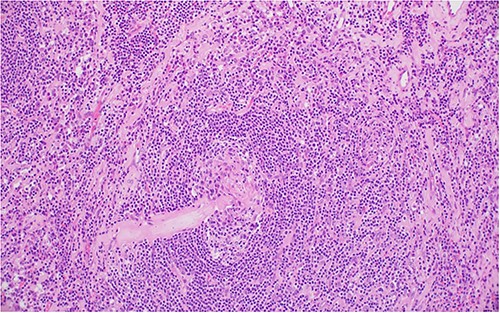 Two germinal centers fused and surrounded by one mantle zone—‘twinning’.