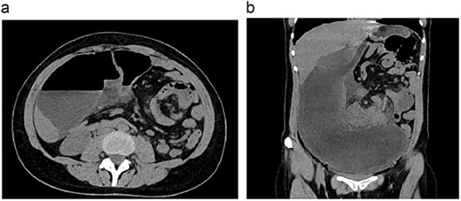 (a) CT, showing bowel loops distended. (b) CT, the volvulus of the small bowel is seen.