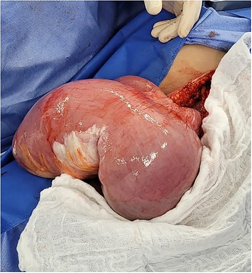 Surgery, small bowel volvulus is completely removed.