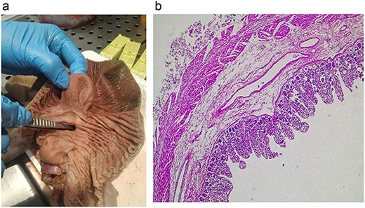 (a) Pathology, the lumen of the diverticulum is shown. (b) Pathology, the diverticulum is seen with all bowel layers.