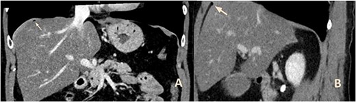 CT of the upper abdomen with frontal (a) and sagittal (b) reconstructions showing the air bubbles above the liver (arrows).