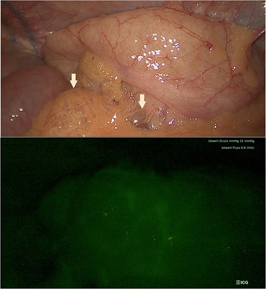 Intraoperative view showing air bubbles embedment in the mesenterium along the ascending colon (arrows) and indocyanine green fluorescence imaging of the bowel perfusion.