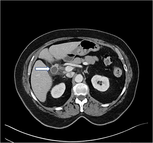 Preoperative CT abdomen/pelvis with IV contrast. In the gallbladder fossa, a 2.2 × 1.9 cm peripherally enhancing tubular/cystic structure is observed (arrow), dilated with air and fluid and contiguous with postsurgical clips, status post cholecystectomy. Moderate surrounding fluid and fatty infiltration are observed. The findings raised the possibility of a dilated remnant cystic duct with superinfection, abscess or less likely, biloma. Neither intrahepatic duct nor common bile duct dilatation was observed. There was concern for probable adjacent secondary duodenitis. Minimal pelvic ascites was observed.
