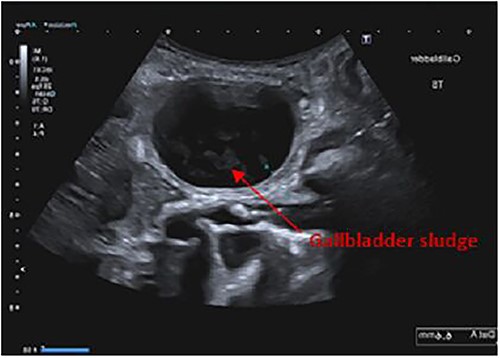 Ultrasound abdomen showing gallbladder sludge.