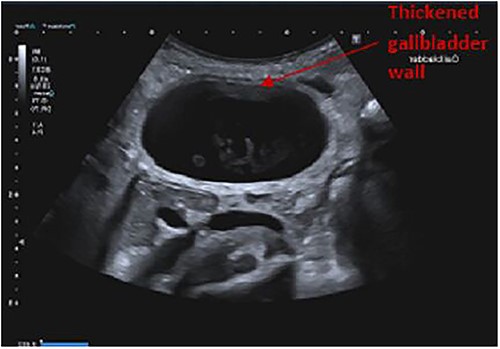 Ultrasound abdomen showing a thickened gallbladder wall.