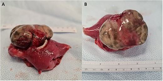Small bowel diverticulum located in the mid-jejunum. (A) Transverse view (B) Superior view. Segment of small bowel 70 mm in length with a maximum internal circumference of 60 mm. There is attached mesentery up to 40 mm thick. There is an outpouching in the serosal surface measuring 85 × 50 × 25 mm. The overlying serosa appeared thinned and was stained green and there was surrounding hemorrhage at the base of the defect within the wall.