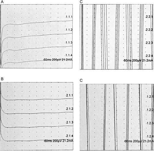 (A) Trigeminal orb oculi bilateral left ipsilateral; (B) Trigeminal orb oculi bilateral right contralateral; (C) Trigeminal orb oculi bilateral right ipsilateral; (D) Trigeminal orb oculi bilateral left contralateral; blink reflex of left R1 and R2 were absent where right R1 and R2 were unrecordable due to interference from the ventilator; this is consistent with facial neuropathy.