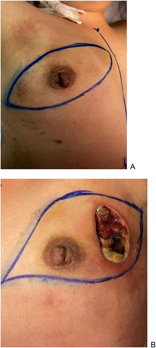 (A) right breast; (B) left breast with a necrotic patch.