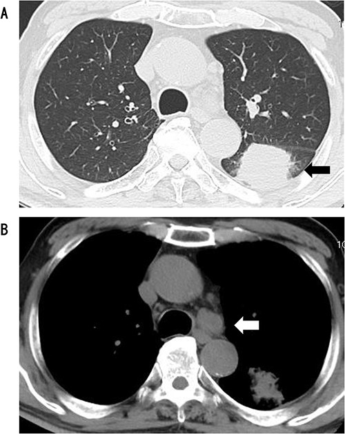 CT showed a circular mass measuring 4.1 cm in the S6 of the left lower lobe (A) and enlarged lymph node #4 (B).