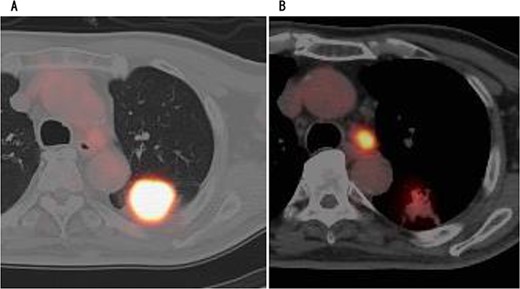 PET showed high accumulation in the mass (A) and lymph node (B).
