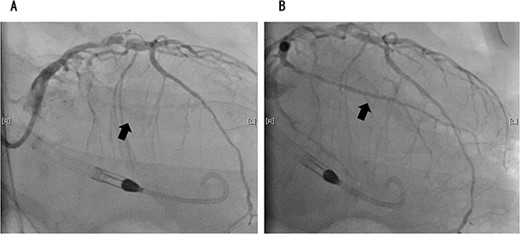 Coronary angiography showed 100% occlusion of the left circumflex branch (A). After the procedure, the occlusion was completely released (B).