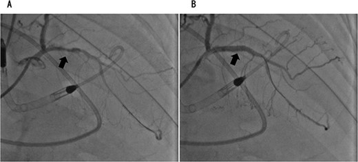 Coronary angiography showed 90% occlusion of the left anterior descending branch (A). After the procedure, the occlusion was completely released (B).