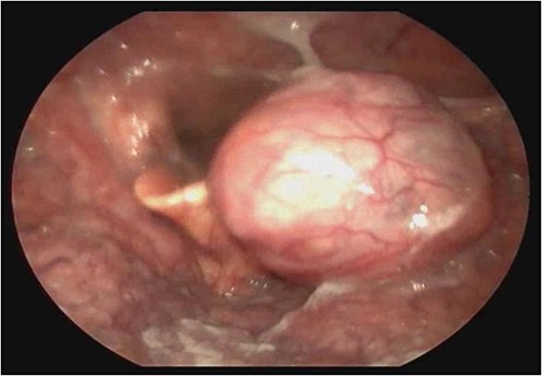 Laryngoscopy showing a vegetating lesion on the lateral wall of the oropharynx.