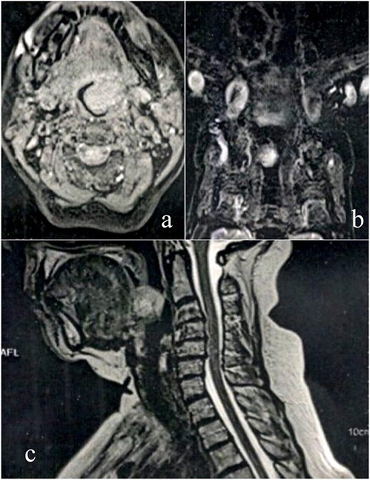 MRI scan shows tumor extension. (a) Axial cranioencephalic section. (b) Coronal section of the chest. (c) sagittal section.