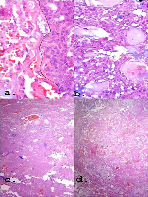 (a) Epithelioid area on the left. (b) Area of triple epithelial cell phenotype (plasmacytoid, myoepithelial and ductal). (c) Highly cellular lesion with a tendency to cellular monomorphism and scarce stromal component. (d) Very limited neoplasm—green India ink—margin surgical HE, ×40.