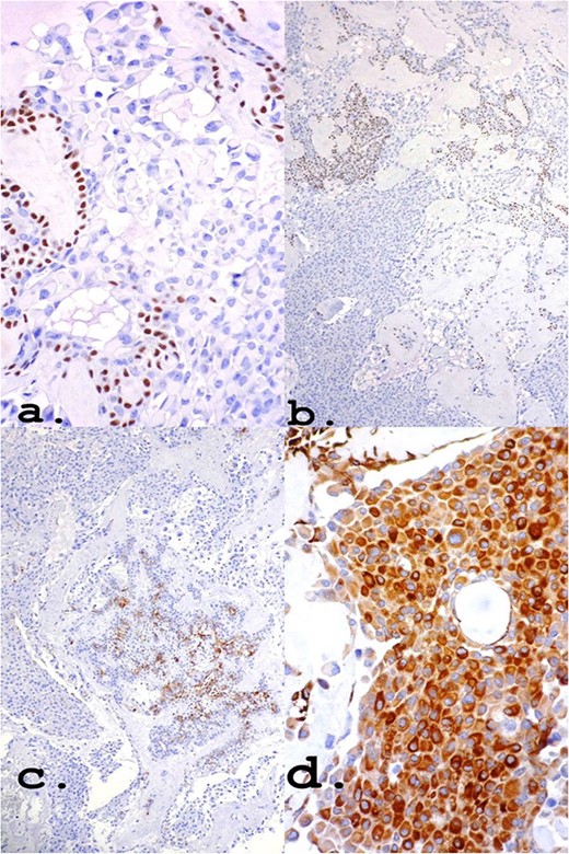 Own nuclear marker of myoepithelial cells (a) and (b): p63 ×40 and ×10, respectively. Markers for epithelial cells (c) and (d): CK7 ×10 and Pancytokeratin (AE1–AE3) ×40, respectively.