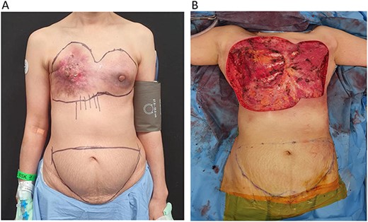 (A) 53-year-old patient with locally advanced breast carcinoma affecting both breasts. (B) Bilateral total mastectomy for locally advanced breast cancer resulted in a massive chest wall defect with exposed ribs.