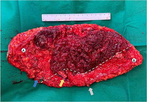 Novel anterolateral thigh–lower medial thigh (ALT–LMT) flap. (A) Denotes the ALT territory whilst (B) denotes the LMT territory, separated by a grey perforated line. The ALT pedicle is denoted by the yellow arrow and the LMT pedicle is denoted by the grey arrow. The GSV was included in the flap to improve venous drainage of this large territory flap (blue arrow).