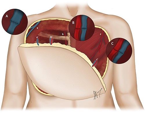 Illustration depicting the orientation of the novel ALT–LMT flap overlying the defect with the corresponding anastomoses. (A) Denotes the end-to-end anastomosis between the great cephalic vein (a) and the GSV (a’). (B) Denotes the end-to-end anastomosis between the internal mammary vessels (b) and the descending branch of the lateral femoral cutaneous vessels (b’). (C) Denotes the end-to-end anastomosis between the thoracoacromial vessels (c) and LMT pedicle (c’) respectively in an end-to-end fashion.