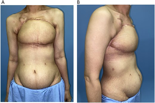 (A) 1-month post chest wall reconstruction with the ALT–LMT flap (AP view). (B) 1-month post chest wall reconstruction with the ALT–LMT flap (lateral view).