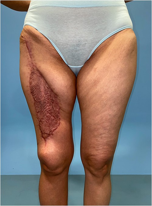 Healed donor site of the ALT–LMT flap with minimal amount of contour deformity and no functional impairment to gait and knee stability.