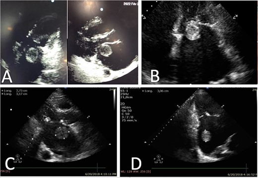 Representative echocardiography images of thrombus ball, (A) TTE views of a thrombus ball blocking the mitral valve (case 1), (B) Apical four chamber view on TTE showing a huge left atrial thrombus ball in contact with mitral valve (case 2), (C) and (D) Left atrial round thrombus on TTE (case 3).