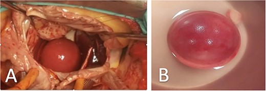 Representative images of surgical views of ‘thrombus ball’, (A) Surgical view of a smooth round ‘thrombus ball’ (case 2), (B) Thrombus ball after surgical removal (case 3).