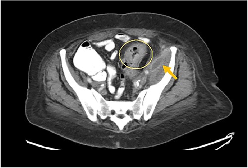 Arrow: psoas abscess. Circle: inflamed colon.