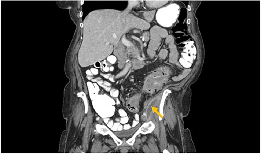Arrow: psoas abscess.