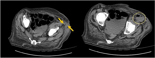 Arrows shows extension of psoas abscess through abdominal wall in the surrounding tissues around the hip. There is not Hip bone involvement. Circle shows abscess next to the hip.