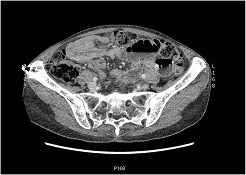 Axial slice of CT abdomen and pelvis showing an intussusception.
