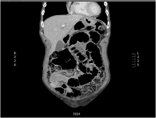 Coronal slice of CT abdomen and pelvis showing an intussusception.