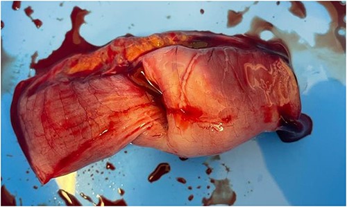 Intraoperative image demonstrating the small bowel intussusception.