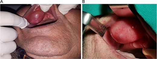 (A & B) Proper retraction of the upper lip shows the extension of the masss in the bucco-labial vestibule.