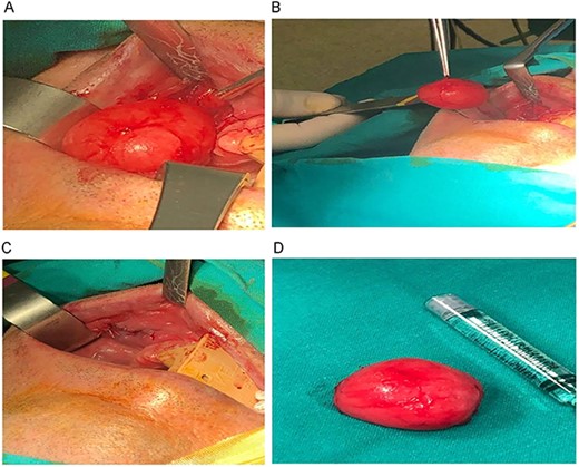(A–D) Sequence of the surgical procedure.