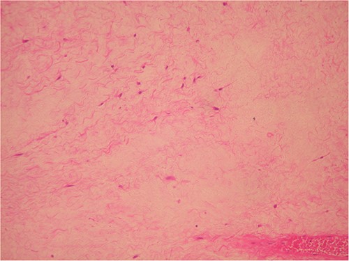 Severe hypocellular tumors. Stellate and spindle cells in abundant myxoid stroma (H & E ×100).