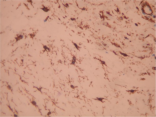 Strong positivity for CD34 of tumor cells (IHC ×200).
