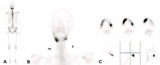 99 m Technetium scintigraphy of the patient showing an intense increased enhancement in the mandible during the late phase. This enhancement was strongest in the anterior portion of the jaw as can be seen in (B) and (C). A: Scintigraphy of the complete body. B: Scintigraphy of the head and neck in coronal direction. C: Scintigraphy of the mandible in axial sections (upper part) and in sagittal section (lower part).