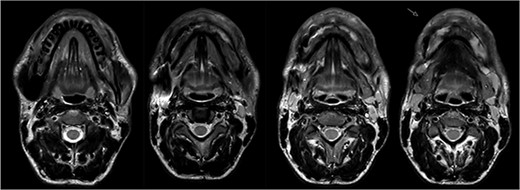 Magnetic resonance imaging (MRI) before bisphosphonate therapy (axial sections). T2 weighting of the MRI shows the high inflammatory activity especially in the anterior portion of the mandible (arrow).