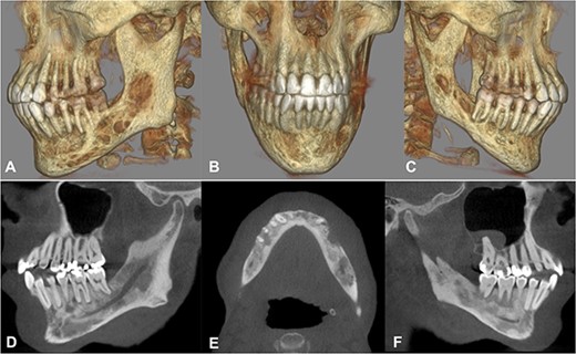 Cone beam computed tomography. A–C) Three-dimensional reconstruction showing the severe destruction of the mandible. D–F) Sagittal and axial sections showing coexisting patchy radiolucent areas within the mandible reaching up to the condyle on both sides.