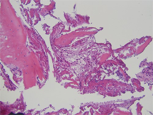 Histopathological specimen showing bone with signs of remodeling and chronic inflammation.
