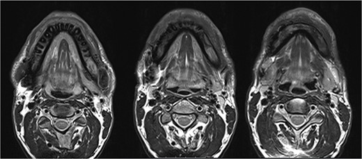 Magnetic resonance imaging (MRI) 3 months after bisphosphonate therapy. T2 weighting shows the significant reduction of inflammatory activity within the mandible after bisphosphonate treatment.