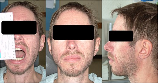 Clinical appearance with a maximum mouth opening of 2.5 cm after three cycles of pamidronate therapy.