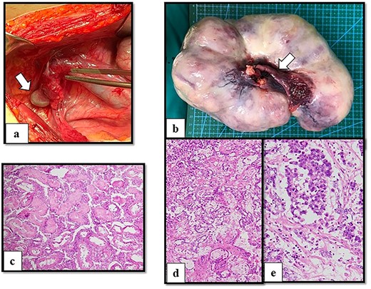 Operative and histological findings. (a) Macroscopic findings of right gonads (arrow) on right lateral pelvic side wall and (b) left gonadal tumor. A Müllerian structure-like, fallopian tube was evident (arrow). Histological examination of (c) atrophic testis and mixed germ cell tumor arising from streak gonad with (d) yolk sac tumor (e) and dysgerminoma. Although seminiferous tubules were identified in the testis, fibrous tissue was detected in the streak gonad.