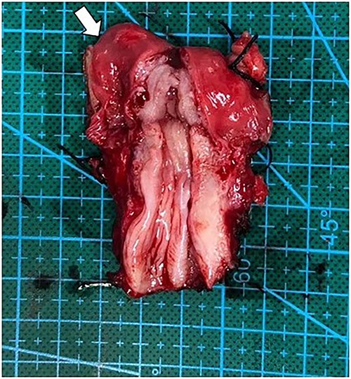 Operative finding of dissected uterus with prepubertal-stage appearance (proportion of cervix equally to uterus) and right fallopian tube (arrow).