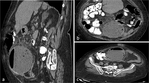 CT scan of the abdomen and pelvis with sagittal (a), coronal (b), axial (c) and views of a well-circumscribed, low attenuation, spherical cystic mass, with internal homogeneous non-enhancing contents and hydro-aerial levels, squalidness of surrounding fat without lymphadenopathy and slightly thickened enhancing wall with mural calcification, located anterior to the right psoas muscle contiguous with the base of the cecum.