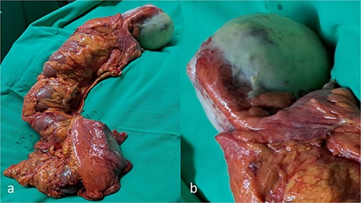 A gross appearance of the right excised colon (a, b). The circumscribed cystic mass overwhelming the appendix and extending over the cecum and extending beside the cecum, and from body to base of the appendix, without base influence (a, b).